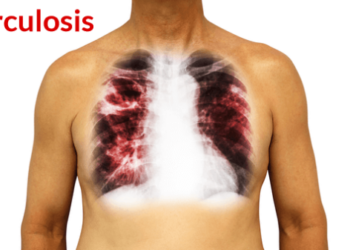 tuberculosis in Nigeria