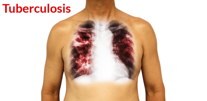 tuberculosis in Nigeria