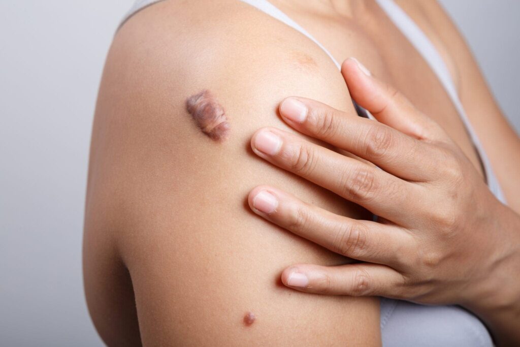 How to Get Rid of a Keloid