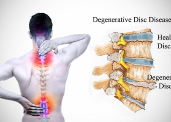 Degenerative Disc Disease