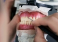 Occlusion - An Overview of Dental Anatomy