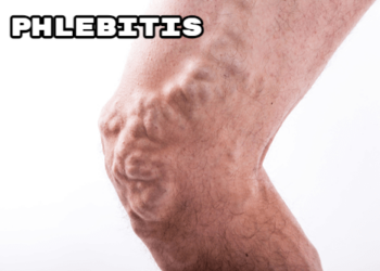 Phlebitis