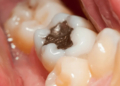 Amalgam Fillings