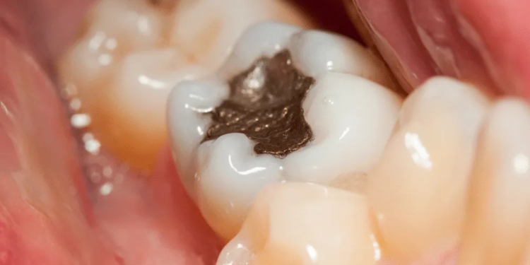 Amalgam Fillings