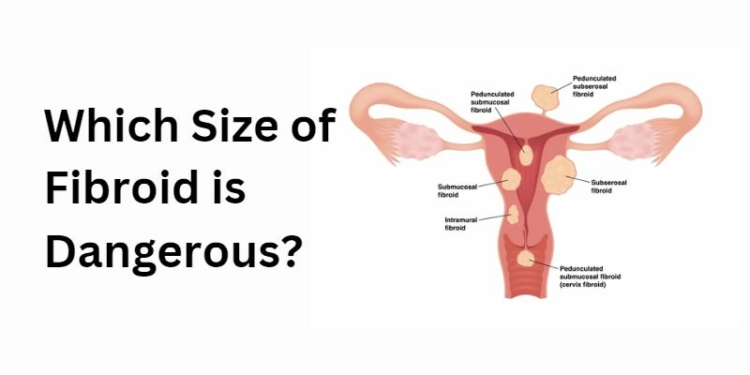 Which Size of Fibroid is Dangerous?