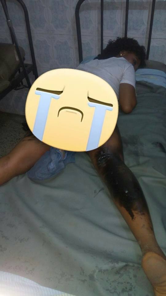 ?The fire started under my buttocks? - Corps member serving in Rivers state gives graphic details + photos of a ghastly accident she recently survived