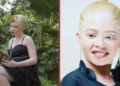 Ayanda Sibanda gets crowned as Miss Albinism Zimbabwe