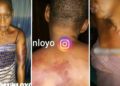 Kemi Olunloyo shows the scars inflicted on her body by Armed robbers