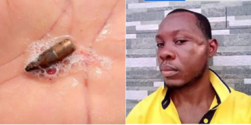 Stray bullet, man who vomited the bullet