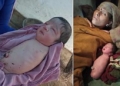 Baby Girl Born With No Arms or Legs Leaves Doctors Baffled