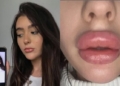 Photos: Lady Left With WEIRDLY SHAPED Lips After Botched Lip Filler Treatment