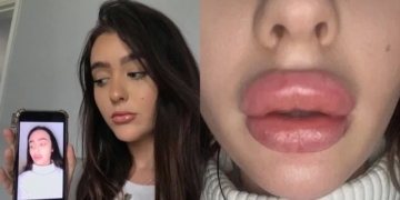 Photos: Lady Left With WEIRDLY SHAPED Lips After Botched Lip Filler Treatment